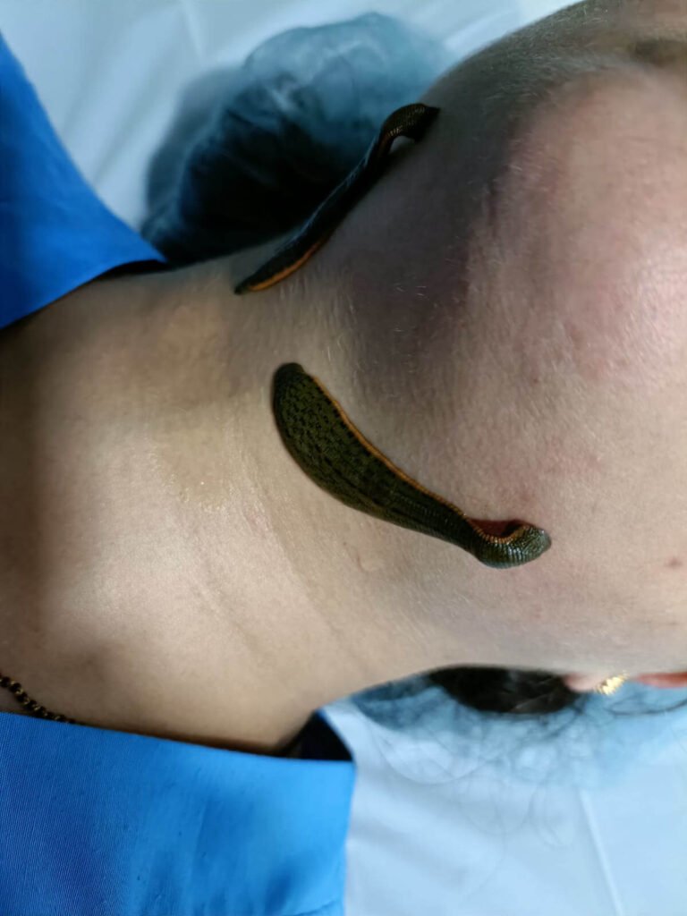 leech therapy for skin diseases and other painful conditions in thane and mumbai